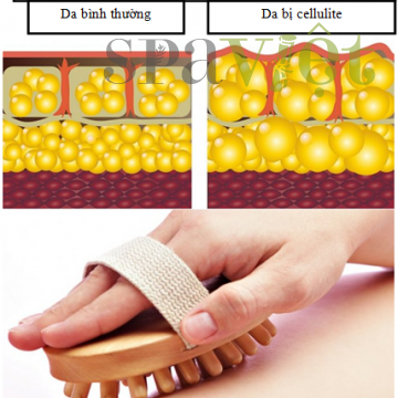 5 giải pháp điều trị Cellutilte ( da sần vỏ cam )